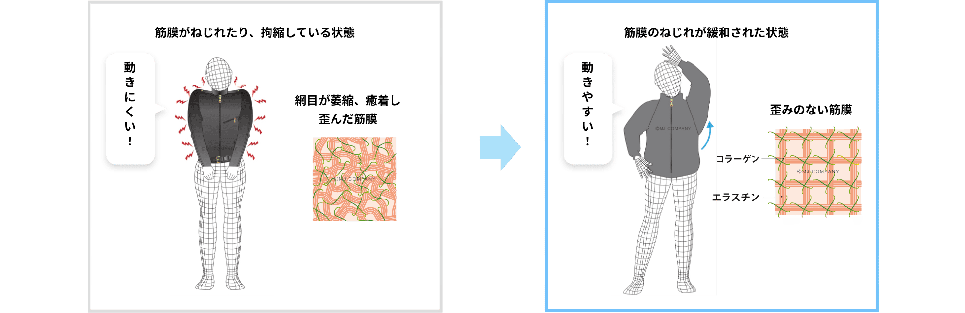 メディセル筋膜療法