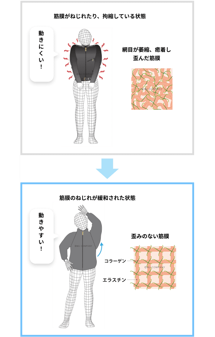 メディセル筋膜療法
